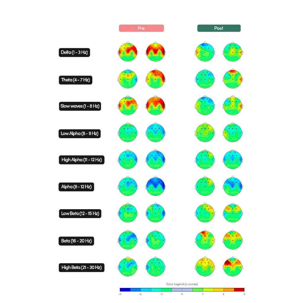 Mapeo cerebral comparativo qEEG